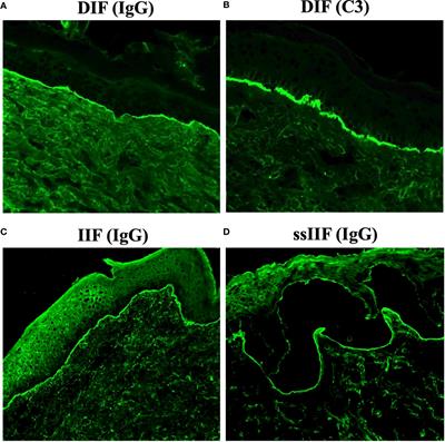 Potential contribution of anti-p200 autoantibodies to mucosal lesions in anti-p200 pemphigoid